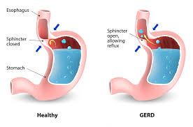 Healthy vs GERD