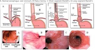 Barrett anatomy